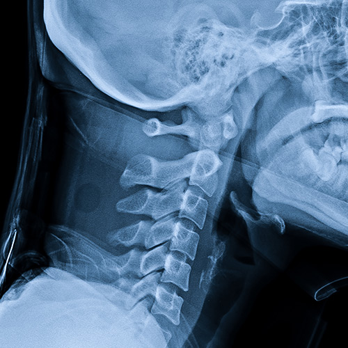X線写真：提携医療機関にてレントゲン写真を撮影し、背骨や骨盤の歪みを正確に分析していきます。